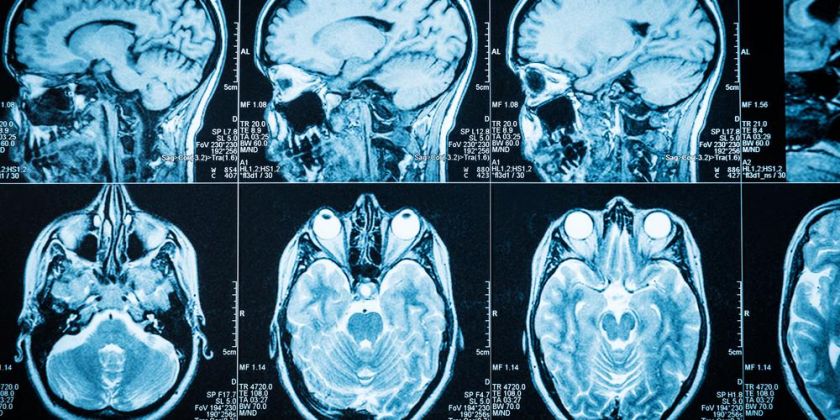 Thumbnail for New research aims to understand why women more likely to develop Alzheimer's disease