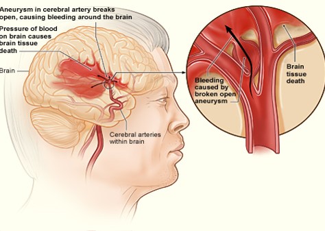 Aneurysm in cerebral artery breaks open, causing bleedign around the brain. Pressure of blookd on brean causes brain tissue death.; sub-image -Expanded section of patholgy in brain: Bleedign caused by broken open aneurysm, brain tissue death.