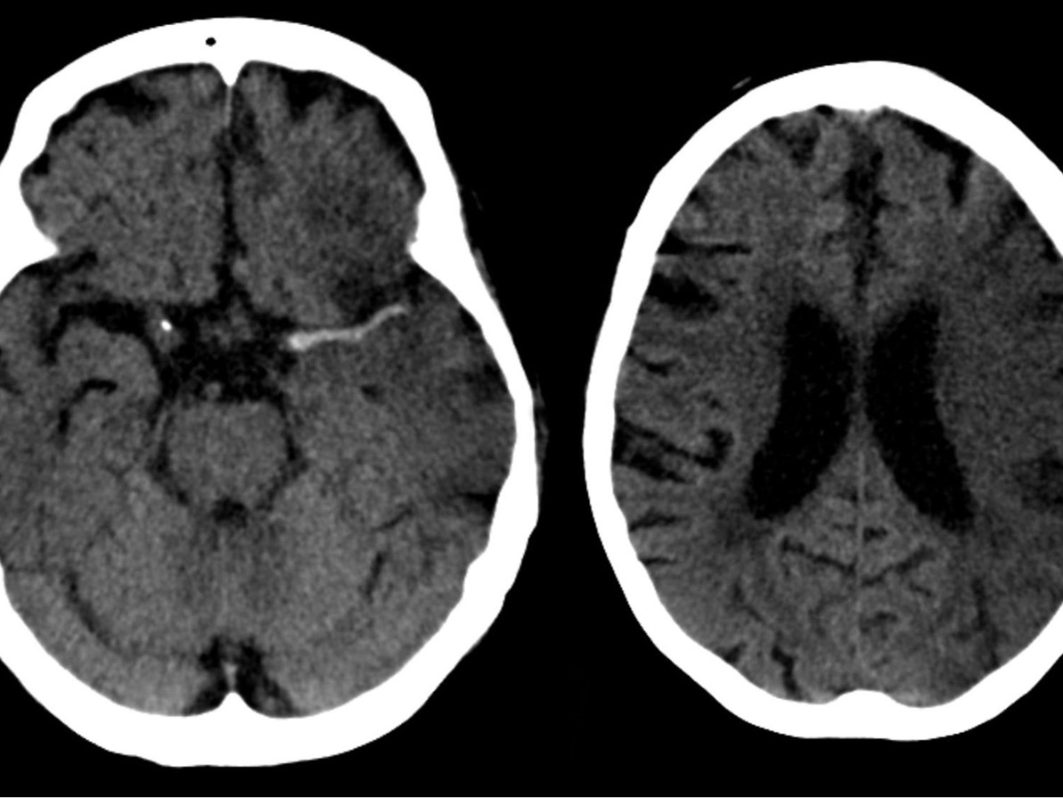 Transection images of brains: left -Haemorrhage; Right-Ischaemia 